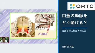 口蓋アンカースクリューはどこが危険？大口蓋動脈を避ける位置と角度