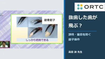 無料公開_抜歯した歯が飛ぶ？誤嚥・窒息を防ぐ鉗子操作
