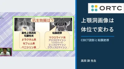 歯科用CBCTで上顎洞をどう読む？体位差とマクロライド療法