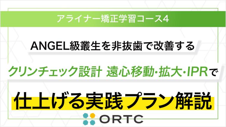 AngleⅠ級叢生を非抜歯で改善するクリンチェック設計 遠心移動・拡大・IPRで仕上げる実践プラン解説