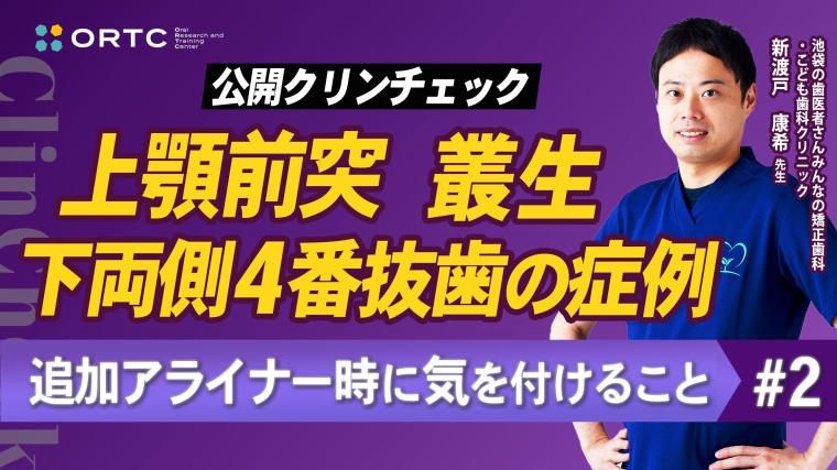 上顎前突、叢生、上下両側4番抜歯の症例、追加アライナー時に気を付けること2