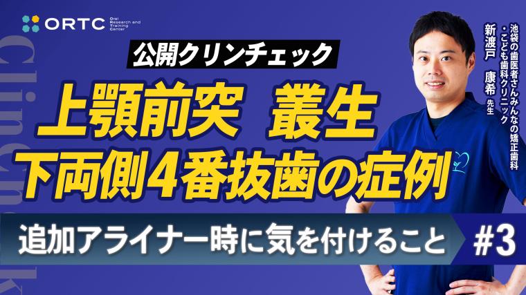 上顎前突、叢生、上下両側4番抜歯の症例、追加アライナー時に気を付けること3