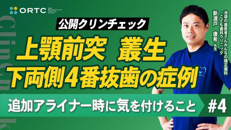 上顎前突、叢生、上下両側4番抜歯の症例、追加アライナー時に気を付けること4