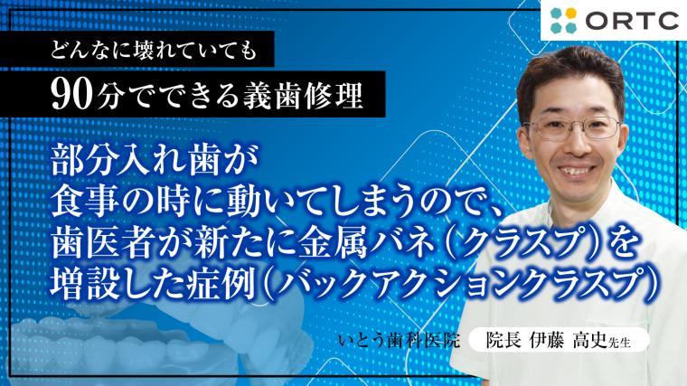 部分入れ歯が食事の時に動いてしまうので、歯医者が新たに金属バネ（クラスプ）を増設した症例（バックアクションクラスプ） 伊藤高史