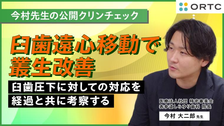 臼歯遠心移動で叢生改善:臼歯圧下に対しての対応を経過と共に考察する 今村 大二郎