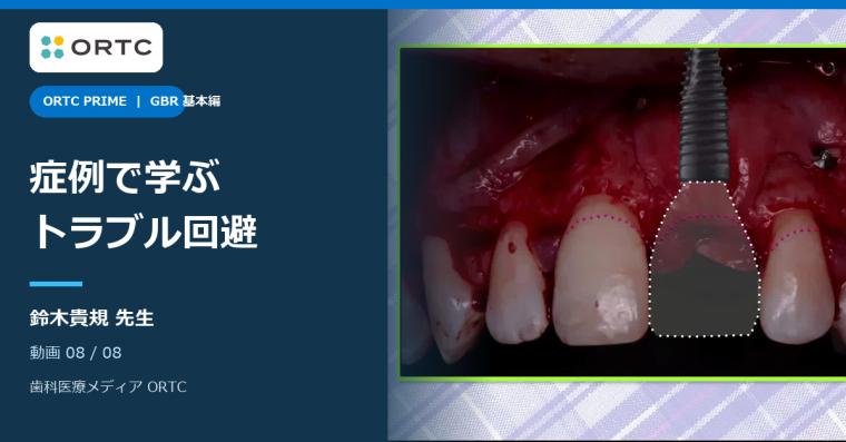 GBRの可能性と必要性 基本編｜症例とトラブル回避 鈴木貴規