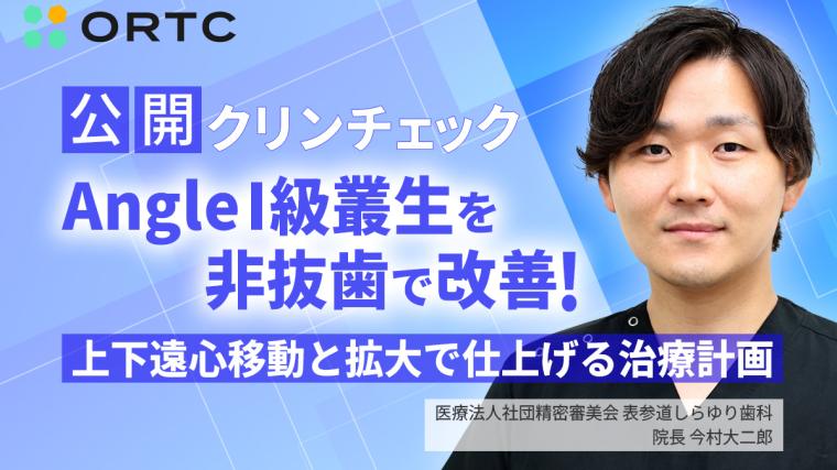 公開クリンチェック Angle1級叢生を非抜歯で改善!上下遠心移動と拡大で仕上げる治療計画