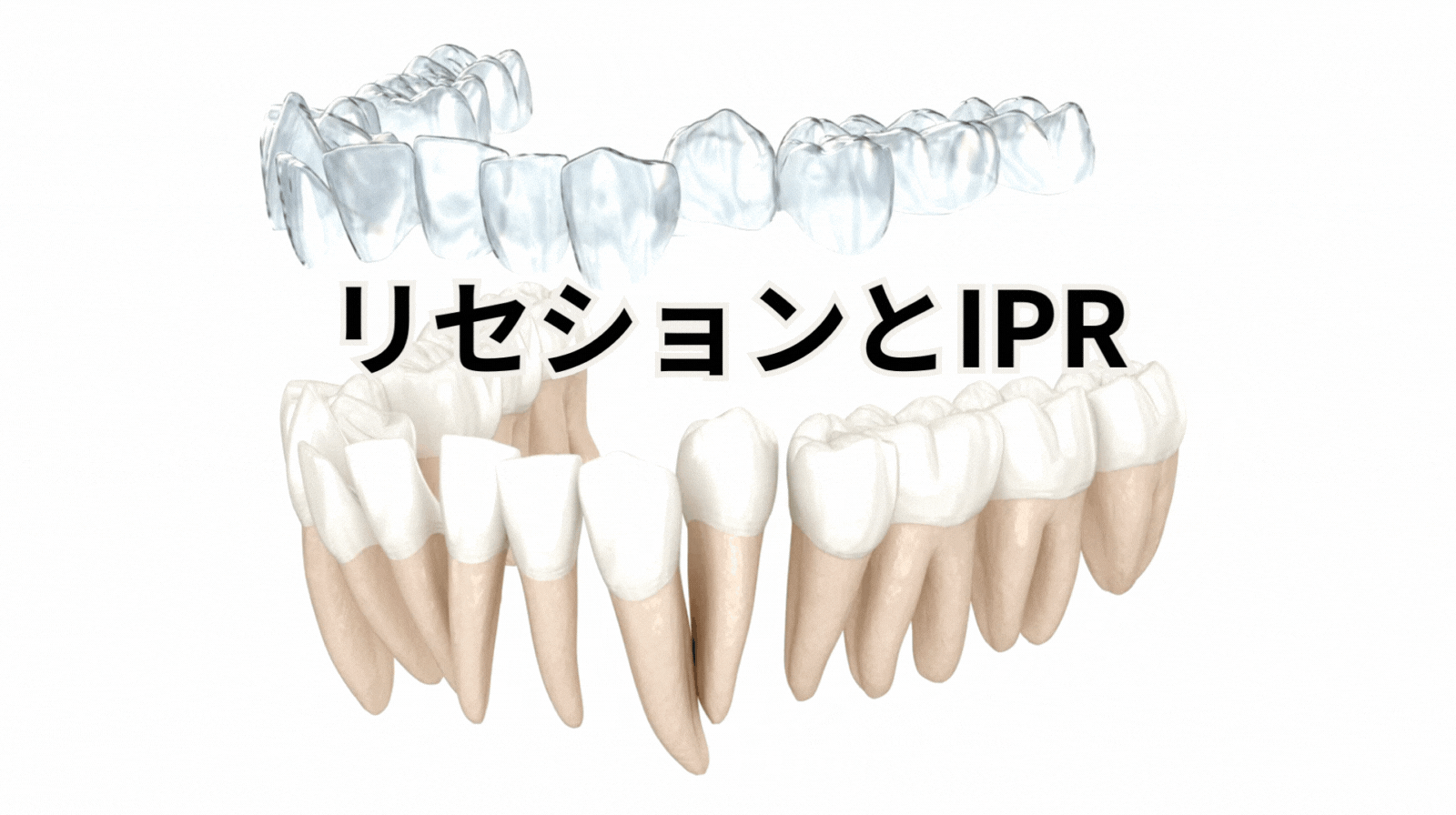アライナー矯正のリセッションとIPRについて
