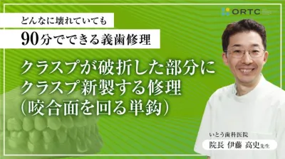 クラスプが破折した部分に、クラスプ新製する修理（咬合面を回る単鈎）
