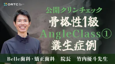 超シンプル！ファーストクリンチェックの7つのポイント　骨格性1級、AngleClass1、叢生症例