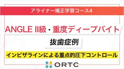 ANGLE II級・重度ディープバイト抜歯症例：インビザラインによる重点的圧下コントロール