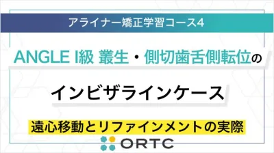 ANGLE I級 叢生・側切歯舌側転位のインビザラインケース：遠心移動とリファインメントの実際