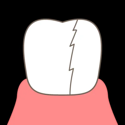歯のマイクロクラック　- 予防と治療のポイント -