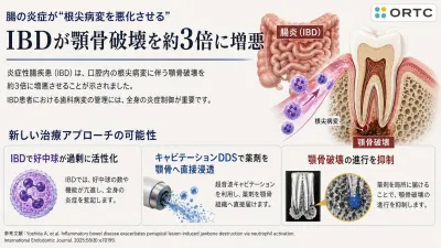 腸の炎症が“根尖病変を悪化させる”ことが判明