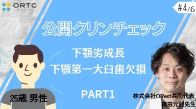 【インビザラインクリンチェック/矯正症例】25歳男性 下顎劣成長 下顎第一大臼歯欠損 PART1