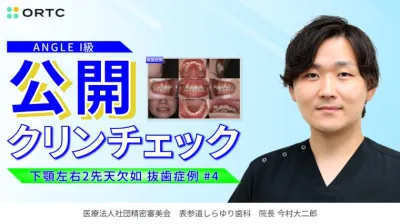 ANGLEI 級 下顎左右2先天欠如(抜歯症例)