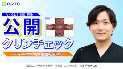 ANGLE II級叢生ディープバイト(抜歯症例)