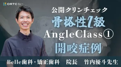 骨格性2級、AngleClass1、開咬症例