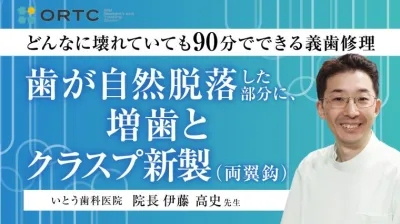 歯が自然脱落した部分に、増歯とクラスプ新製（両翼鈎）