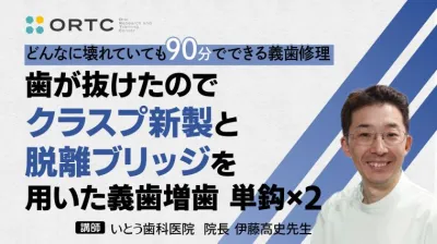 歯が抜けたのでクラスプ新製と脱離ブリッジを用いた義歯増歯　単鈎×2