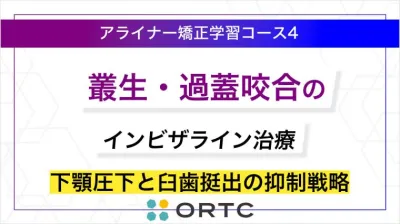 叢生・過蓋咬合のインビザライン治療：下顎圧下と臼歯挺出の抑制戦略