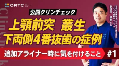 上顎前突、叢生、上下両側4番抜歯の症例、追加アライナー時に気を付けること1