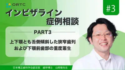 上下顎とも舌側傾斜した狭窄歯列および下顎前歯部の重度叢生PART3