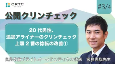 20代男性、追加アライナーのクリンチェック 上顎2番の捻転の改善?