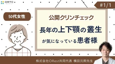 公開クリンチェック_50代女性・長年の上下顎の叢生が気になっている患者様