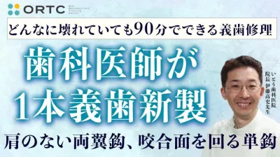 歯科医師が義歯新製（肩のない両翼鈎、咬合面を回る単鈎）