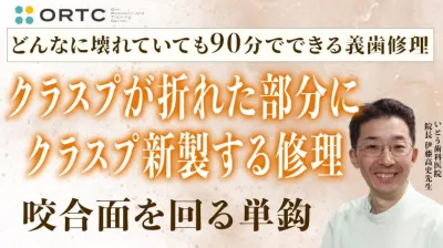 クラスプが折れた部分にクラスプ新製する修理（咬合面を回る単鈎）