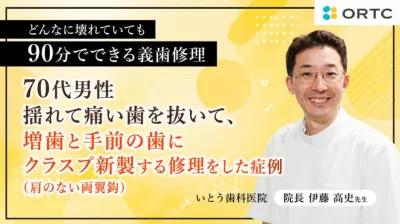 70代男性揺れて痛い歯を抜いて、増歯と手前の歯にクラスプ新製する修理をした症例（肩のない両翼鈎）