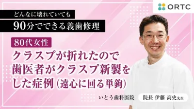 80代女性、クラスプが折れたので歯医者がクラスプ新製をした症例（遠心に回る単鉤）