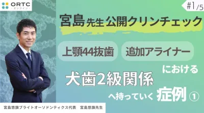 宮島先生公開クリンチェック 上顎44抜歯、追加アライナーにおける犬歯2級関係へ持っていく症例1